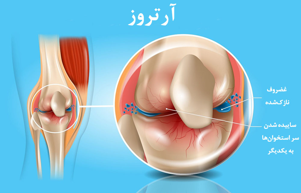 آرتروز