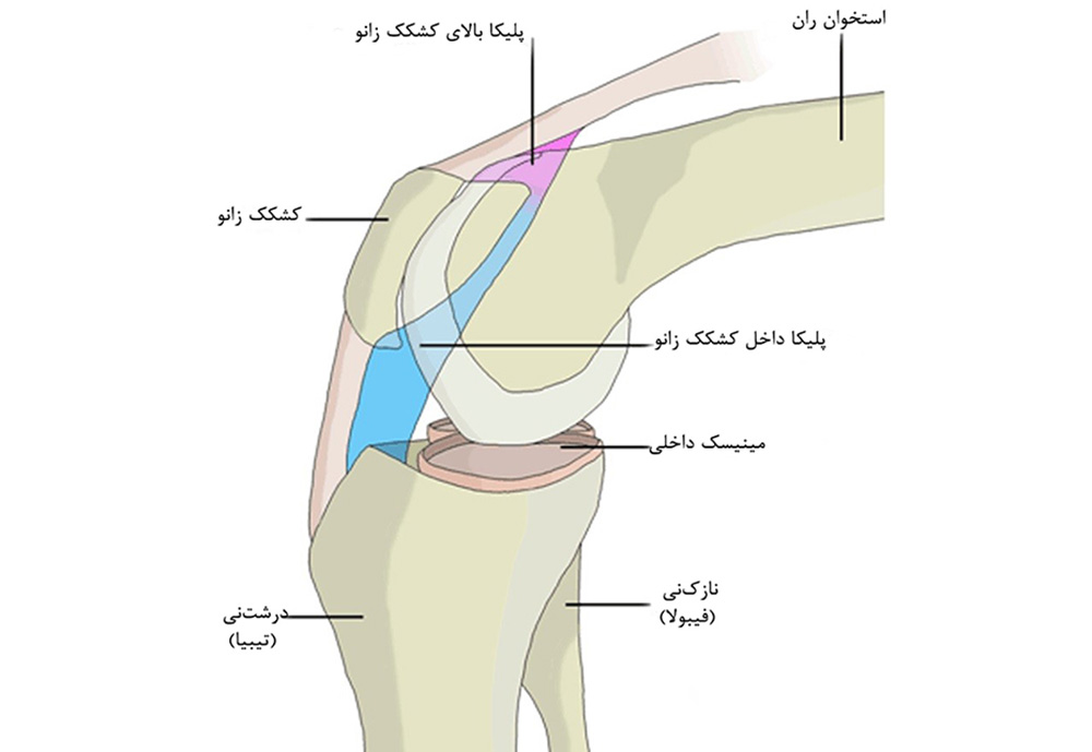 سندروم پلیکا