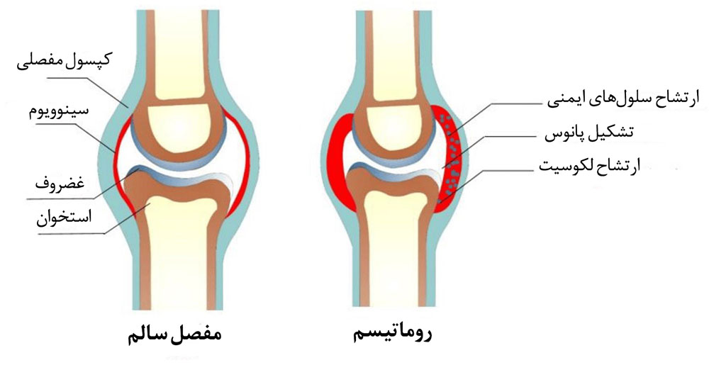 رماتیسم