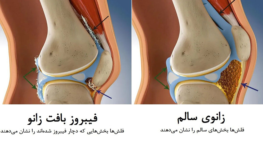 آرترو فیبروز