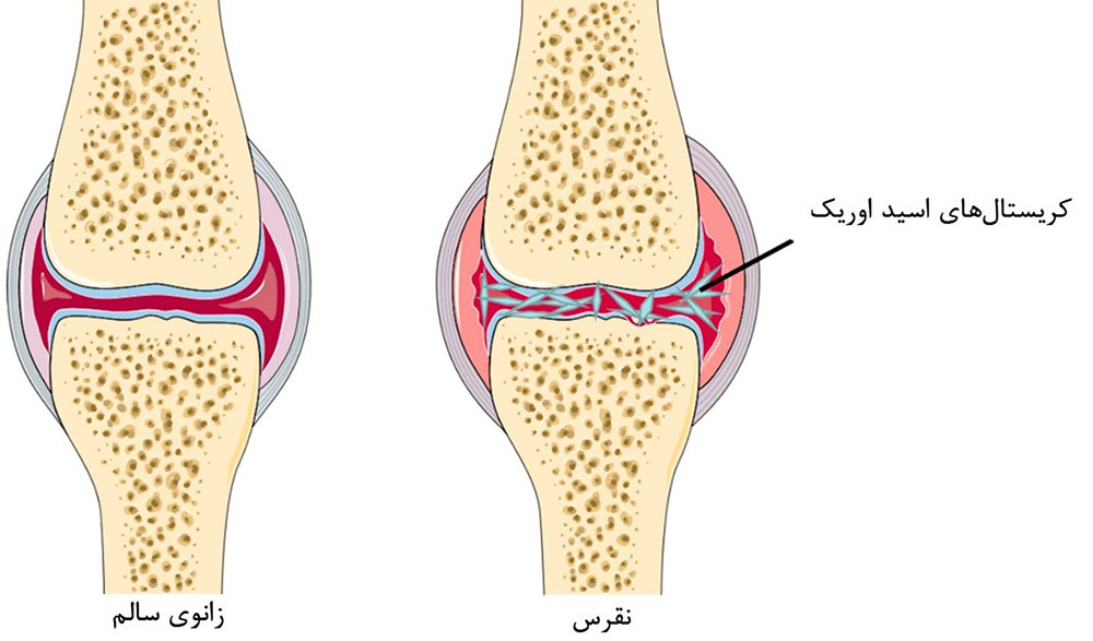 نقرس