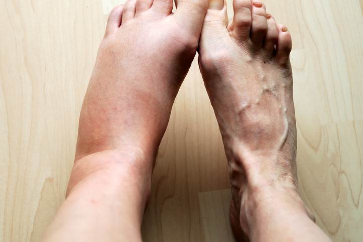 ارتباط ورم پا و تیروئید چیست و برای کاهش ورم پا چه باید کرد؟