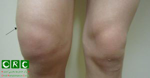 برای کاهش ورم زانو بر اثر ضربه و آسیب چه باید بکنیم؟