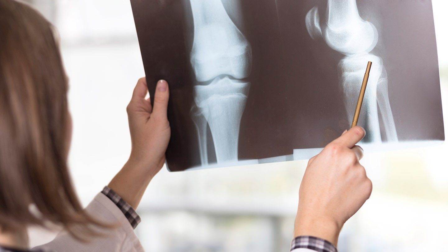 تفاوت روماتیسم و آرتروز فرق علت و علائم آرتریت روماتوئید با آرتروز