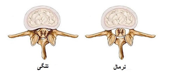 تنگی کانال نخاعی چیست؟ درمان تنگی تنگی کانال نخاعی کمر و گردن