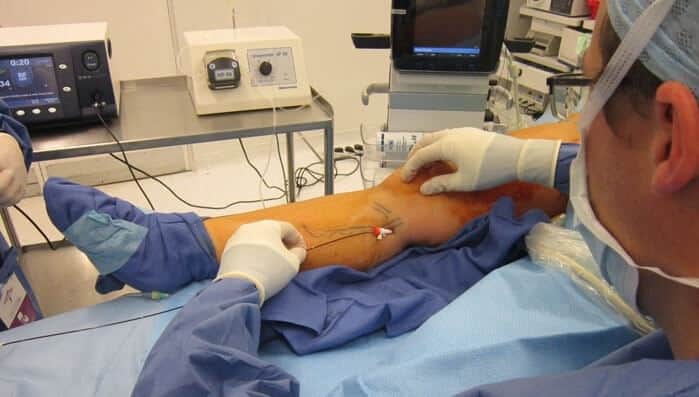 رادیوفرکوئنسی برای بلاک عصب زانو