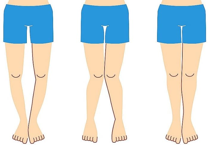 زانوی ضربدری و پای پرانتزی