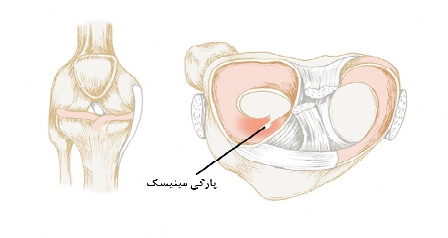 علائم پارگی مینیسک زانو
